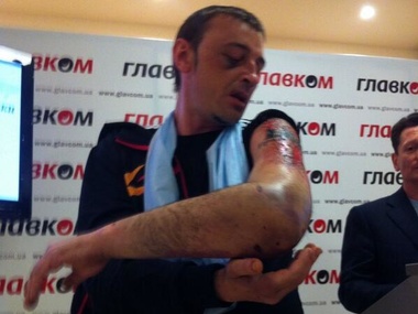 В Донецке террористы пытались срезать татуировку "Слава Украине!" с руки похищенного шахтера