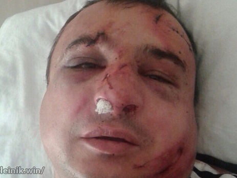 В Киеве избили луганского сепаратиста Клинчаева