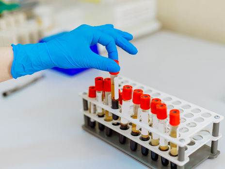 За сутки коронавирус подтвердили у 442 украинцев. Зафиксировано наименьшее число летальных случаев с начала мая 