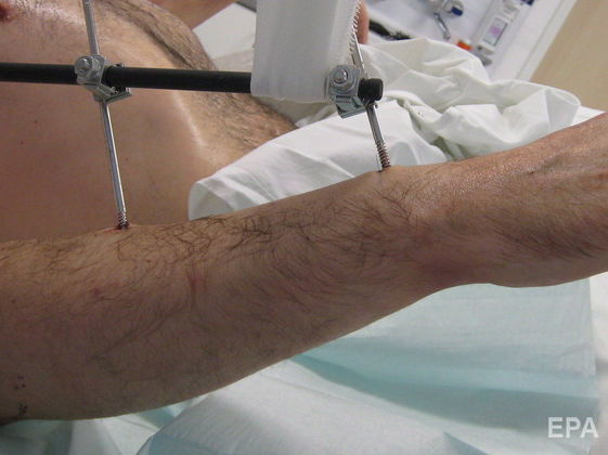Французские врачи провели первую в мире операцию по пересадке обеих рук и плеч