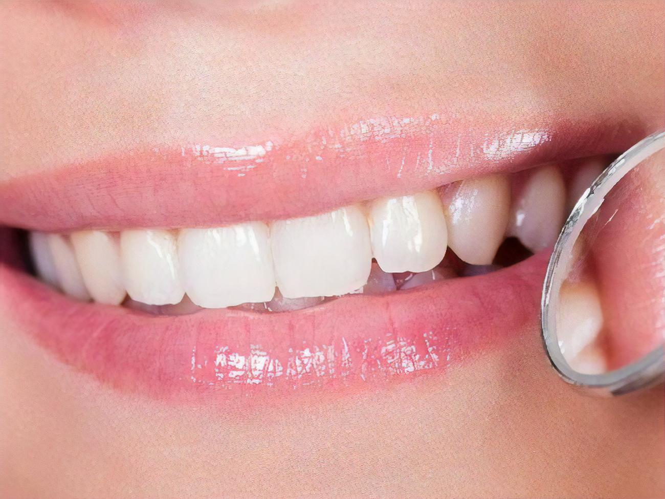 Види пломб для зубів: які пломби найбільш довговічні?