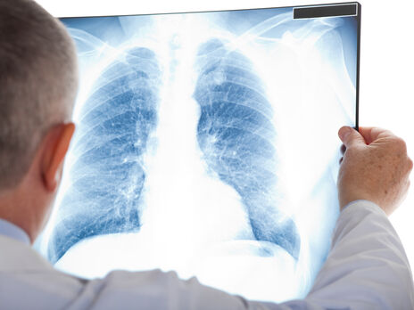 В США женщине пересадили зараженные коронавирусом легкие, она умерла