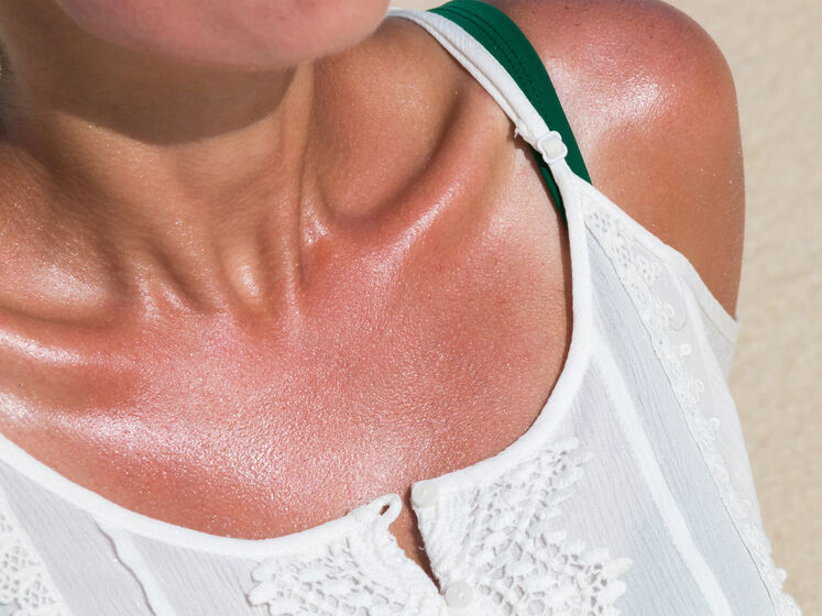 Ці чотири дії допоможуть шкірі під час сонячного опіку. Дерматолог і косметолог розповіли про ефективні заходи