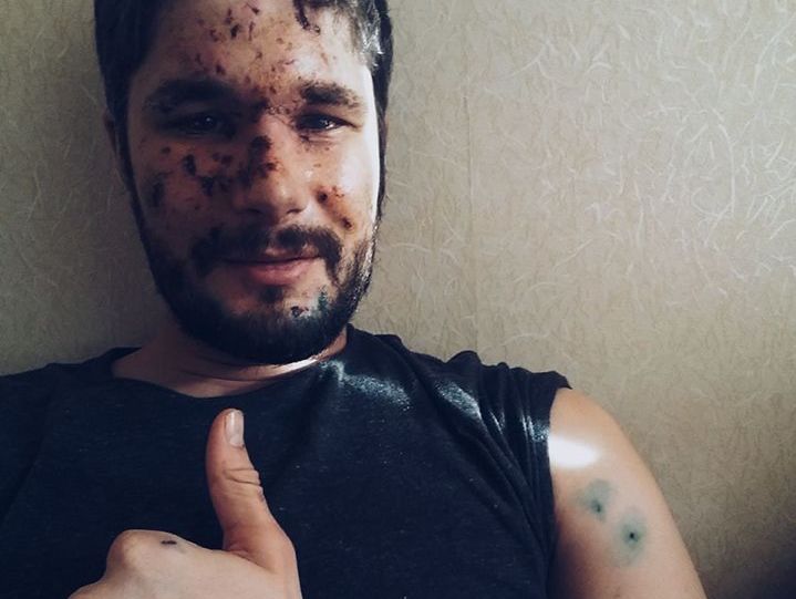 Британский фотограф, раненный в Авдеевке: Врачи сумели спасти мой левый глаз