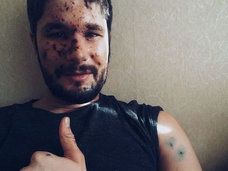 Британский фотограф, раненный в Авдеевке: Врачи сумели спасти мой левый глаз