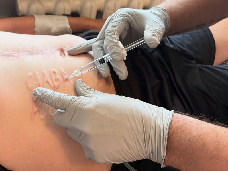 "Отправная точка без этих мерзких слов". Хирург рассказал, как убирает с тела украинского военного шрам "Слава России". Фото