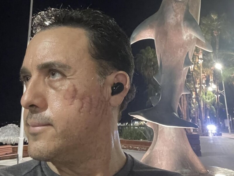 Мексиканский биолог надеется снова встретить акулу, укусившую его за голову