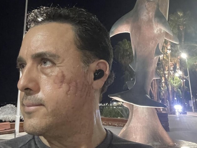 Мексиканский биолог надеется снова встретить акулу, укусившую его за голову