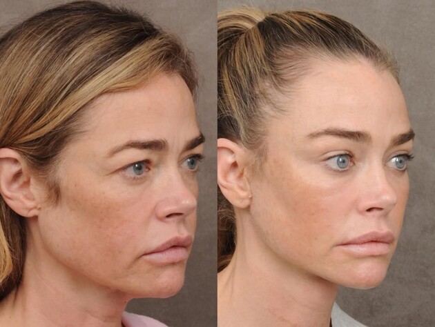 Одна из самых красивых актрис в мире сделала подтяжку лица. Фото до и после