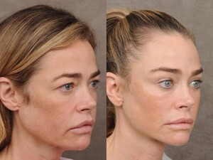 Одна з найгарніших акторок у світі зробила підтяжку обличчя. Фото до й після