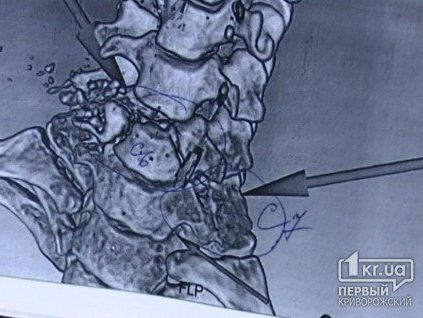 Главврач больницы имени Мечникова: У раненного в Кривом Роге журналиста крайне тяжелое состояние