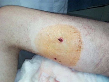 Волонтер Доник о ранении Дейдея: Тут точно нужно петицию пилить, чтоб героя дали