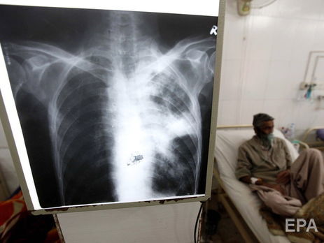 Туберкулез остается самой смертоносной болезнью в мире – Всемирная организация здравоохранения