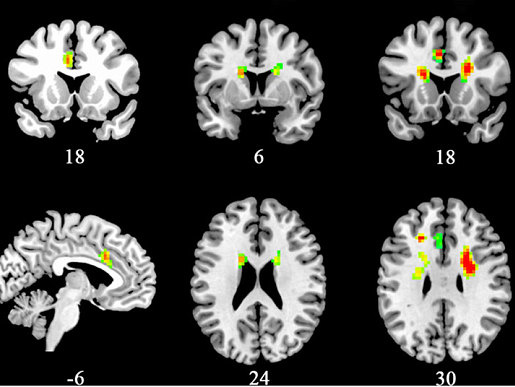 Ученые проследили за воздействием любви на мозг