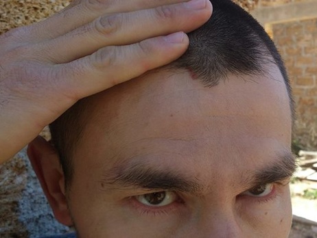 Крымский правозащитник показал фото побоев, нанесенных в ФСБ