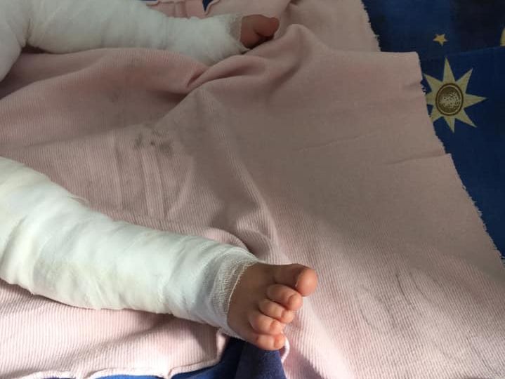 В Одеській області 11-місячна дитина впала у відро з окропом