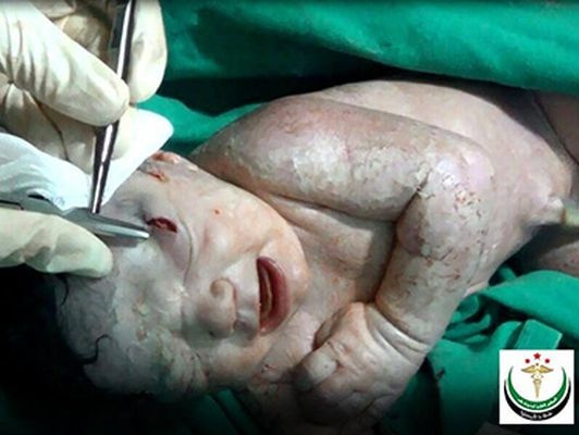 В сирийском Алеппо родилась девочка со шрапнелью в голове