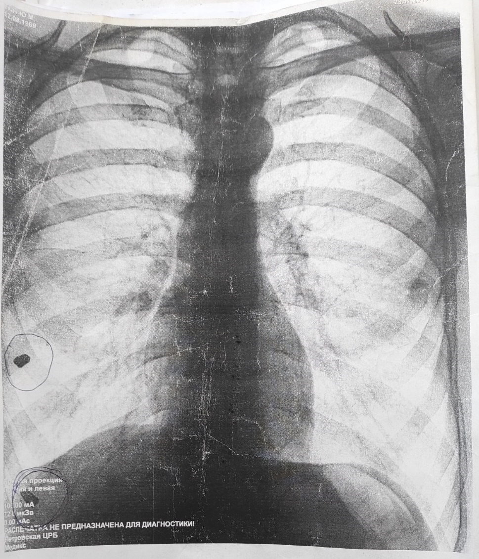Рентгеновский снимок груди из архива Юрия Ткача. Кругом обведены пули. Фото предоставлено Юрием Ткачом